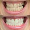 GLOティースホワイトニングキット歯Bluetooth専用アプリGLOLITTEETHWHITENINGDEVICETECHKITWITHBLUETOOTH家電